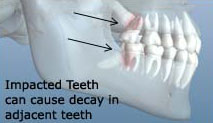 wisdom teeth graphic